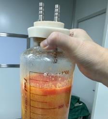 巴音郭楞水动力吸脂手术要做多久？